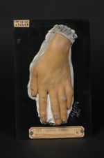 Lupus érythémateux de la main. Homme âgé de 45 ans, employé