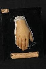 Gale ; éruption symptomatique polymorphe des mains. Homme âgé de 15 ans, cordonnier