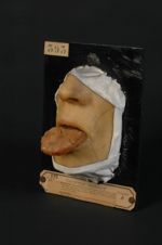 Épithéliome spino-cellulaire sur leucoplasie de la langue, avec infiltration cancéreuse de toute la  [...]