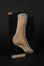 Varices lymphatiques ulcérées d'origine vraisemblablement tuberculeuse (Inv. 1922). Guérison par le  [...]