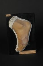 Varices lymphatiques de la peau, tumeur cutanée lymphatique. Homme âgé de 49 ans, menuisier