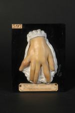 Dactylite tuberculeuse ; périotiste externe fongueuse, gommeuse. Homme âgé de 15 ans, sans professio [...]