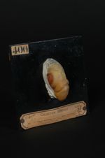 Chancre syphilitique sur le gland ; plaques syphilitiques coexistantes sur le fourreau de la verge.  [...]