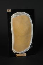 Lichen scrofulosorum ; cicatrices scrofuleuses. Homme âgé de 20 ans, graveur