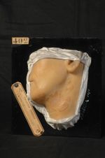 Trichophytie circinée du cou. Homme âgé de 26 ans, ébéniste