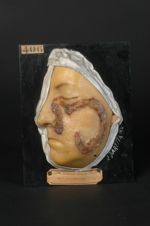 Syphilide ulcéro-croûteuse serpigineuse du nez et de la joue gauche. Homme âgé de 33 ans, employé