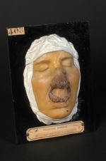 Syphilide pustulo-crustacée du nez et de la lèvre supérieure. Femme âgée de 47 ans, épailleuse