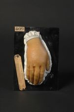 Dermite artificielle aiguë chez une cuisinière (Inv. 1922). Femme âgée de 45 ans. Eczéma aigu, vésic [...]