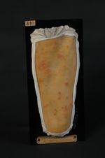 Dermatite herpétiforme de Dühring. Femme âgée de 54 ans, crosseuse