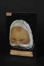 Chancre syphilitique du front. Homme âgé de 35 ans, menuisier