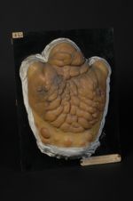 Naevus fibromateux vasculo-pigmentaire généralisé, progressif, hypertrophique (V. le n° 416, avant-b [...]