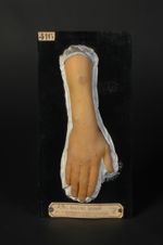 Naevus fibromateux vasculo-pigmentaire généralisé, progressif, hypertrophique (V. le n° 415, thorax  [...]