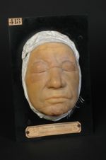 Mycosis, lymphadénie cutanée. Homme âgé de 72 ans, concierge. (V. !e n° 419, avant-bras du même mala [...]