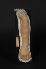 Mycosis, lymphadénie cutanée. Homme âgé de 72 ans, concierge. (V. le n° 418, face du même malade)