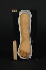 Erythème multiforme ; grandes plaques papuleuses rouge bleu. Femme âgée de 39 ans, journalière