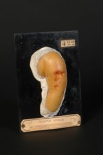 Vaccine. Ulcérations non syphilitiques du bras consécutives à la vaccine. Fillette âgée de 12 mois