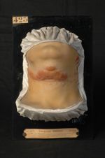 Trichophytie circinée et sycosique du cou. Homme âgé de 30 ans, boucher