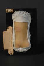 Favus circiné du poignet. Homme âgé de 16 ans, menuisier