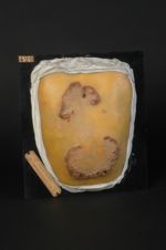 Syphilide tuberculo-crustacée serpigineuse du dos. Femme âgée de 30 ans, concierge