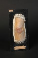 Gommes scrofulo-tuberculeuses ulcérées du bras. Femme âgée de 23 ans, frangeuse