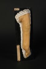 Lymphangite gommeuse syphilitique de l'avant-bras. Homme âgé de 53 ans, tailleur