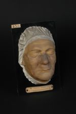 Lupus érythémateux de la face : érythème centrifuge de Biett, herpès crétacé de Devergie, etc. Homme [...]