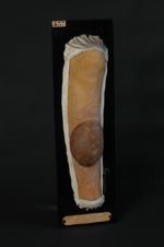 Bulle hémorragique sur un placard d'eczéma chronique de la jambe chez un sujet cachectique (Inv. 192 [...]