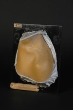 Plaques syphilitiques circinées (Inv. 1922). Syphilide papulo-squameuse circinée du cou et du dos. F [...]