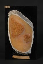 Eczéma impétigineux de la cuisse. Homme âgé de 57 ans, maçon