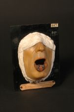 Naevocarcinome de la lèvre supérieure, avec adénopathie (Inv. 1922). Homme âgé de 59 ans, tisseur. S [...]