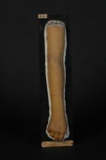 Prurigo de Hebra (Inv. 1922). Femme âgée de 16 ans, blanchisseuse. Lichen, prurigo