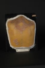 Dermatose indéterminée survenue au cours d'une syphilis secondaire maligne. Homme âgé de 23 ans, faï [...]