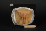 Plaques syphilitiques végétantes de la vulve. Femme âgée de 21 ans, cuisinière