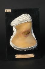 Gomme syphilitique ulcérée du cou. Homme âgé de 35 ans, bijoutier