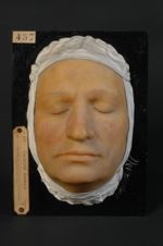 Acné rosée, acné érythémato-pustuleuse de la face. Homme âgé de 43 ans, boulanger