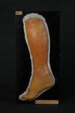 Eczéma craquelé de la jambe. Homme âgé de 56 ans, entrepreneur