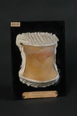 Acné chéloïdienne de la nuque. Femme âgée de 23 ans, domestique