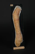 Mycosis fongoïde ; lymphadénie cutanée. Tumeurs, taches érythémateuses infiltrées, et lésions eczéma [...]