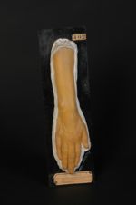 Sclérodermie en bande à la phase atrophique (?) (Inv. 1922). Femme âgée de 27 ans, journalière (V. l [...]