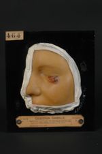 Epithéliome, probablement baso-cellulaire, de la paupière inférieure, type ulcus rodens (Inv. 1922). [...]