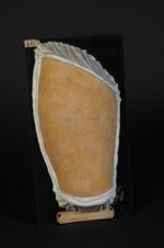 Lichen plan de la cuisse. Homme âgé de 59 ans, peintre