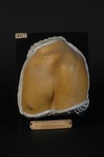 Roséole syphilitique, roséole ortiée, forme lenticulaire et forme circinée, de l'épaule, du thorax e [...]