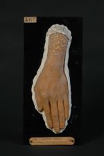 Pemphigus : altérations des ongles. Homme âgé de 70 ans, concierge