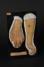 Sarcomatose de Kaposi (Inv. 1922). Homme âgé de 68 ans, jardinier. Sarcomatose généralisée. Sarcome  [...]