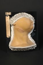 Lupus tuberculeux de la région sous-maxillaire droite. Cicatrice chéloïdienne consécutive à la destr [...]