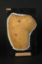 Syphilide secondaire ulcérante du dos, syphilis maligne précoce. Homme âgé de 26 ans, journalier