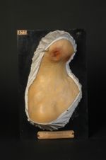 Gommes syphilitiques ulcérées du cou, cicatrices syphilitiques. Homme âgé de 50 ans, menuisier