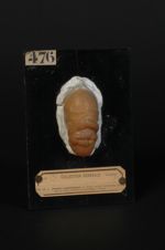 Plaques syphilitiques du gland ; variété diphtéroïde. Homme âgé de 18 ans, ciseleur