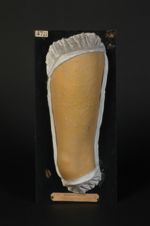 Psoriasis ; poussée aiguë. Femme âgée de 24 ans, domestique