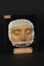 Lupus tuberculeux du nez, cicatrisé ; reprise d'activité de quelques éléments. Femme âgée de 28 ans, [...]